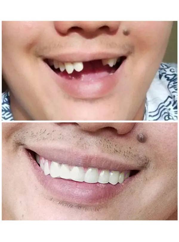 Image of Natural Shade Medium Custom Fit Instant Smile Teeth - Before and After Image